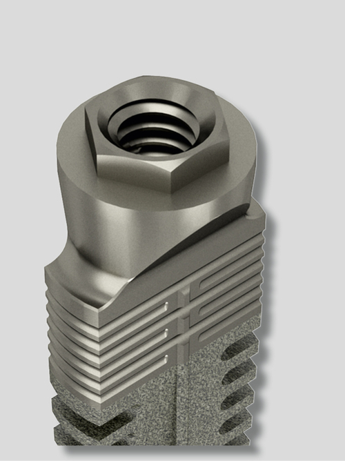 Impianti a forma di cuneo